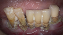 old-bad-teeth